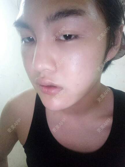 更美 - GD.的经验 | 美购日记 | 自体脂肪丰额头 | 郑州