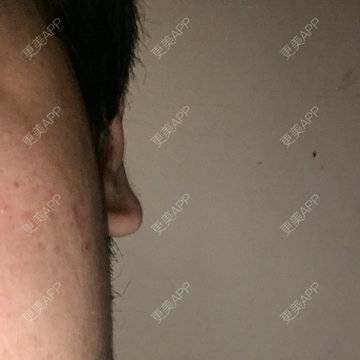 更美 - 青春、讓人想念讓人醉的经验 | 耳部矫正 | 杭州