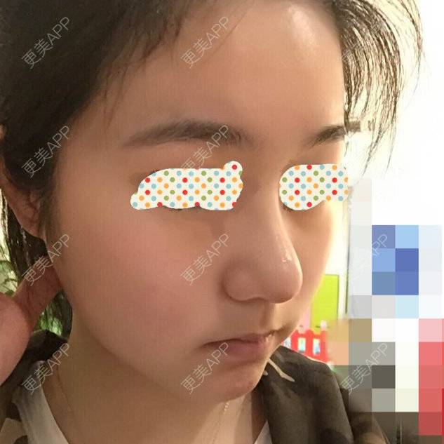 更美 - 偏执狂艾米米介雪瑶的自体脂肪隆鼻经验 | 上海 | 自体脂肪隆鼻 | 自体软骨隆鼻 | 鼻头塑形
