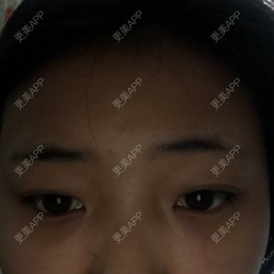 更美 - 美肤最重要的经验 | 激光淡化黑眼圈 | 天津