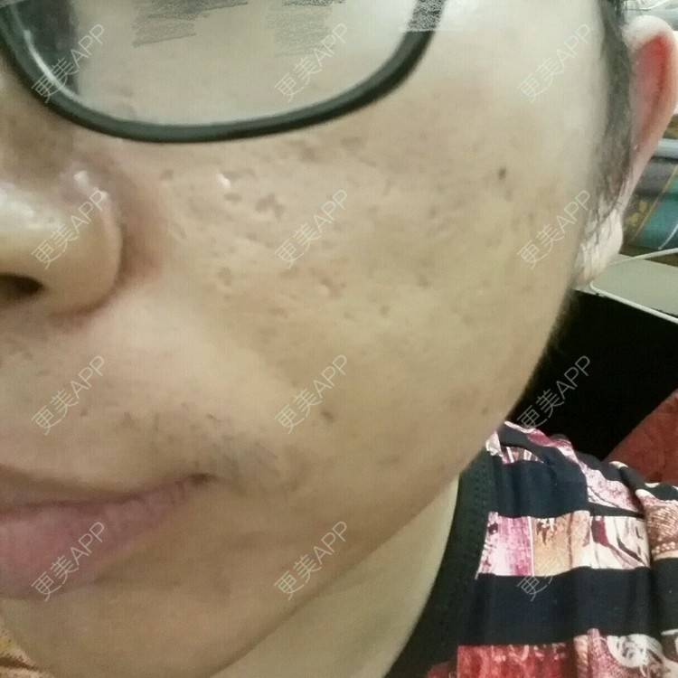 更美 - Rogerlaw的经验 | 疤痕值皮 | 像素激光 | 点阵激光1 | 深圳