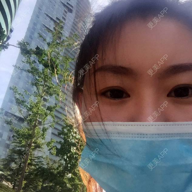 更美 - 更美用户17UYHv42VB的经验 | 注射溶脂瘦脸
