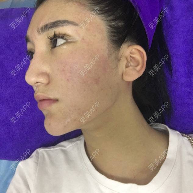 张子婷的超声提升日记