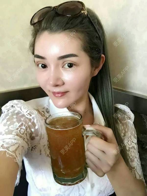 更美 - 马熙妍的双眼皮修复经验 | 修复双眼皮 | 切开割双眼皮 | 全切双眼皮修复 | 双眼皮修复 | 北京