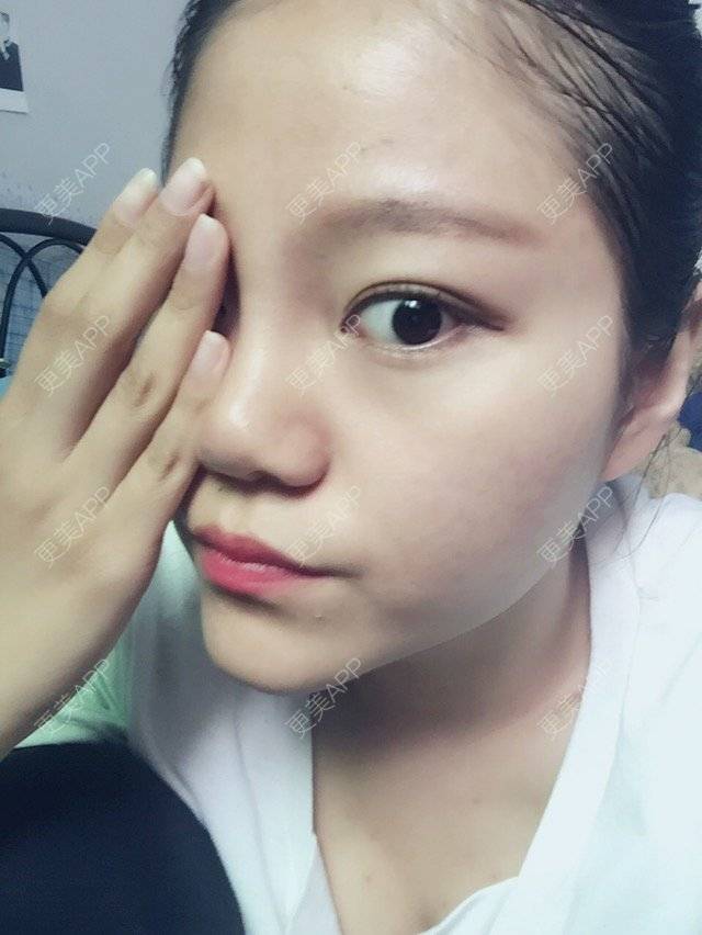 更美 - 更美用户11594843的经验 | 隆鼻 | 咸阳