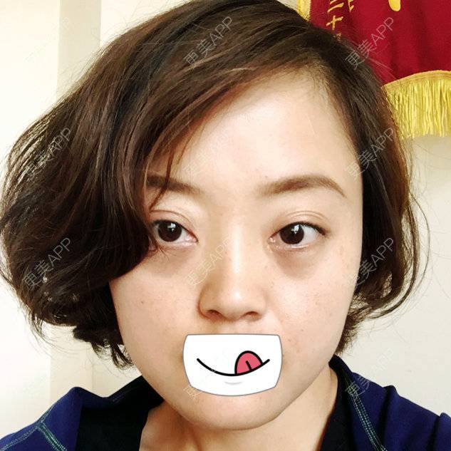 更美 - 寂静的样子的外切去眼袋经验 | 术后求抱抱 | 外切去眼袋 | 杭州 | 眼部整形