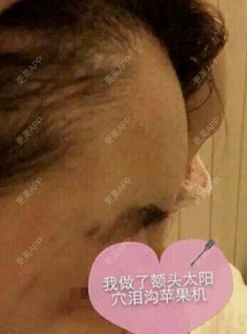 更美 - 吃多饭的胶原蛋白丰面颊经验 | 上海 | 胶原蛋白丰面颊 | 皮肤美容 | 胶原蛋白