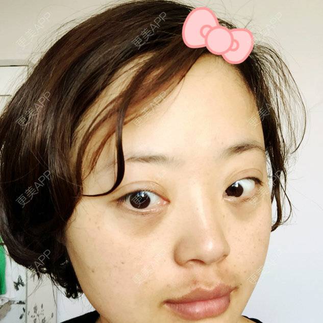 更美 - 寂静的样子的外切去眼袋经验 | 术后求抱抱 | 外切去眼袋 | 杭州 | 眼部整形