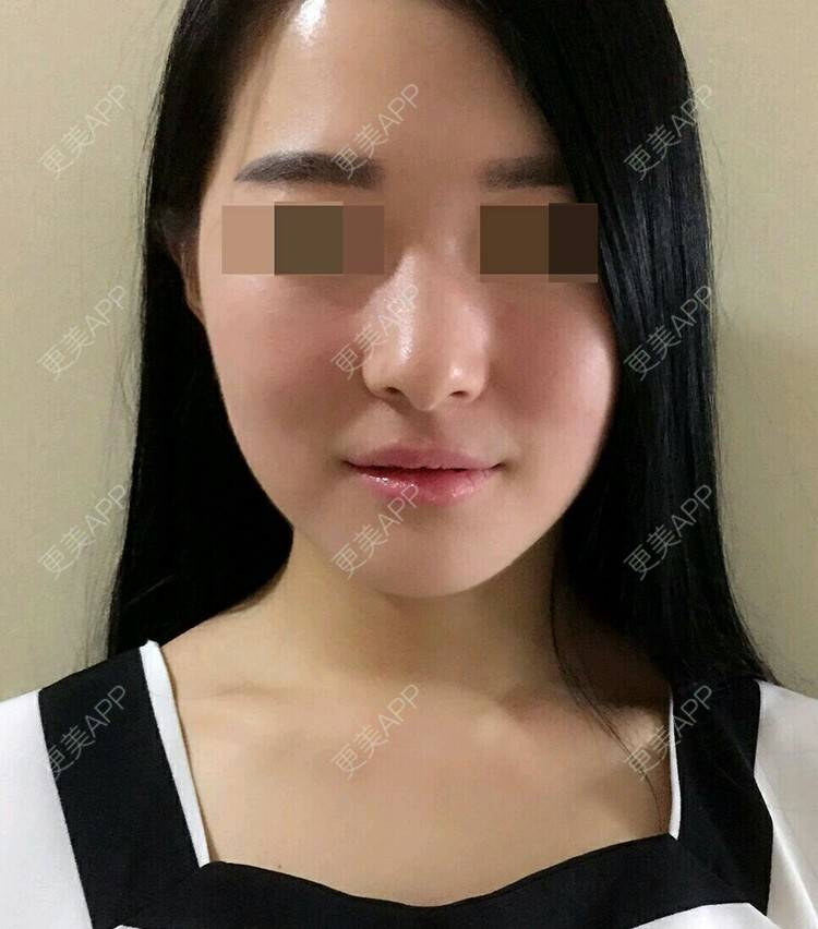 更美 - 宋洋 医生的镭射净肤经验 | 晒对比照 | 镭射净肤 | 西安