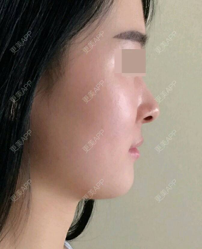 更美 - 宋洋 医生的镭射净肤经验 | 晒对比照 | 镭射净肤 | 西安