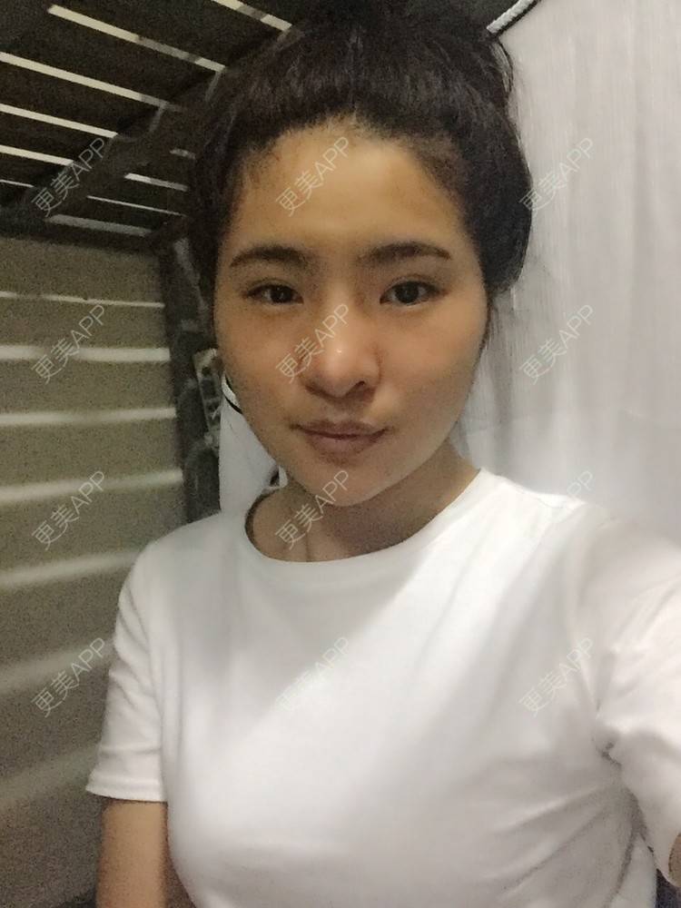 更美 - Y·的经验 | 鼻部多项 | 双眼皮 | 鼻部多项 | 上饶
