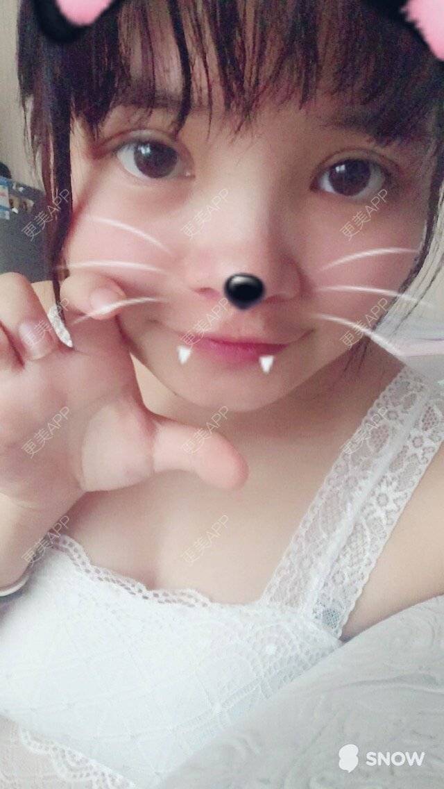 更美 - fresh🍭的双眼皮经验 | 美购日记 | 我要减肥 | 第三天 | 双眼皮 | 武汉