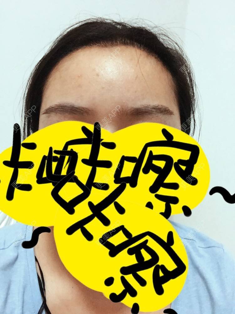 更美 - Luckyly的植睫毛经验 | 发际线移植 | 眼部整形 | 美购日记 | 植睫毛 | 广州