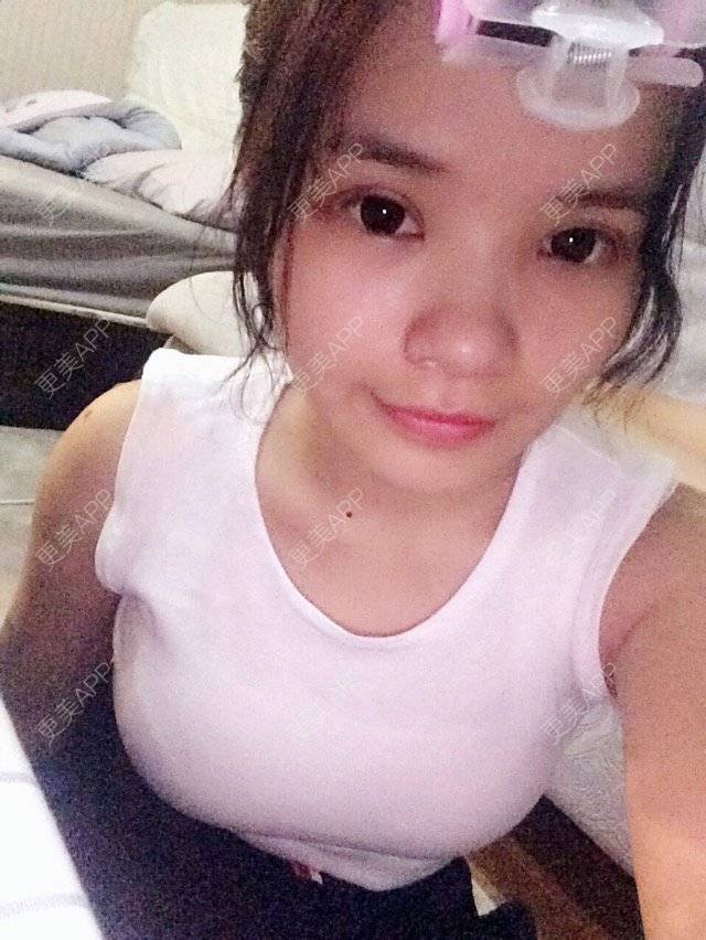 更美 - fresh🍭的双眼皮经验 | 美购日记 | 我要减肥 | 第三天 | 双眼皮 | 武汉