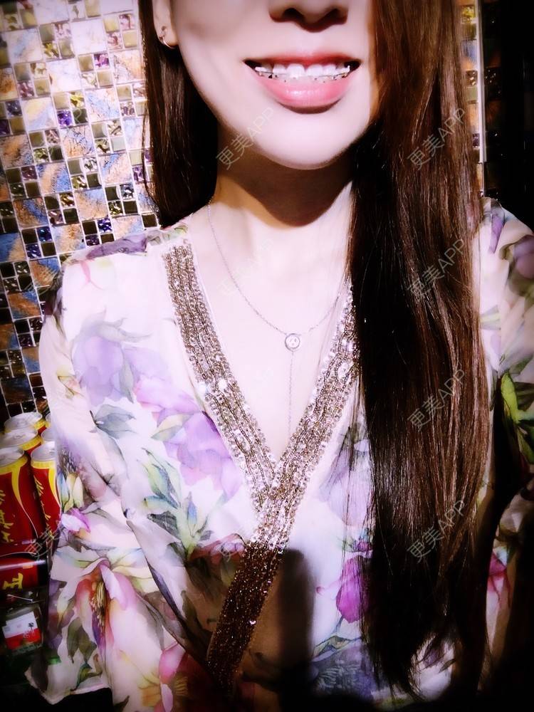 更美 - 硕硕7873的牙齿矫正经验 | 牙齿矫正 | 口腔齿科 | 虎牙 | 石家庄