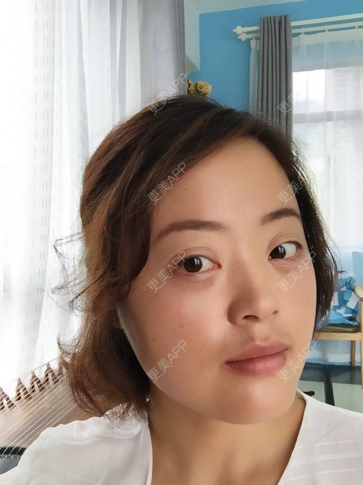 更美 - 寂静的样子的外切去眼袋经验 | 外切去眼袋 | 杭州