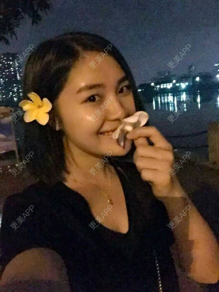 更美 - 倔强的石头的玻尿酸鼻部经验 | 玻尿酸隆下巴 | 玻尿酸鼻部 | 瑞蓝玻尿酸 | 东莞