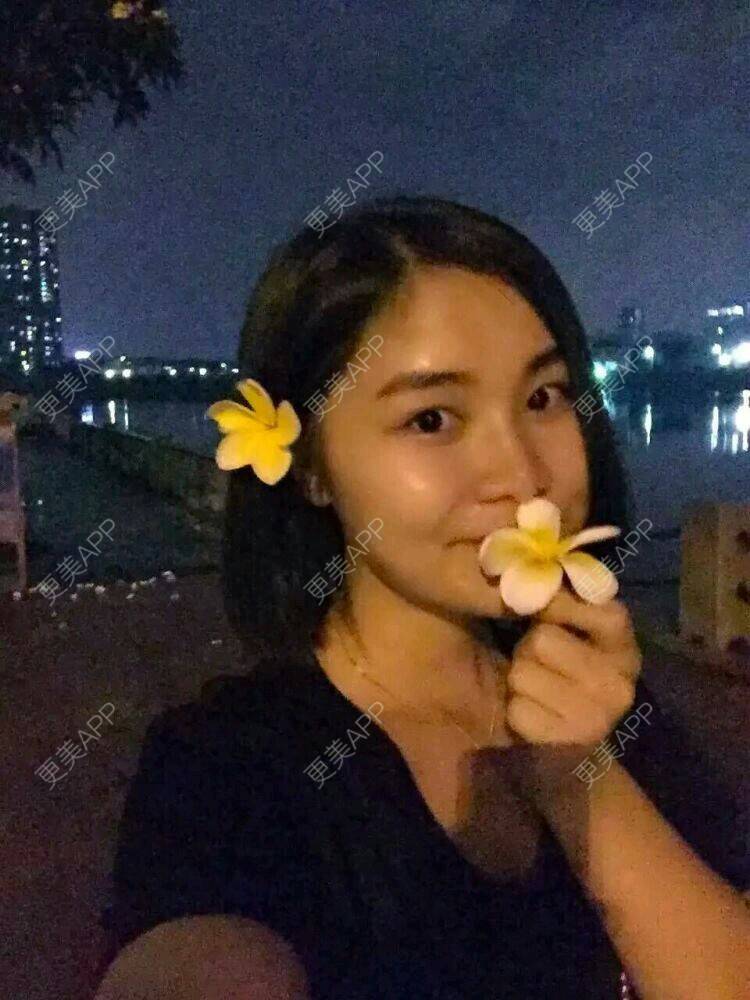 更美 - 倔强的石头的玻尿酸鼻部经验 | 玻尿酸隆下巴 | 玻尿酸鼻部 | 瑞蓝玻尿酸 | 东莞