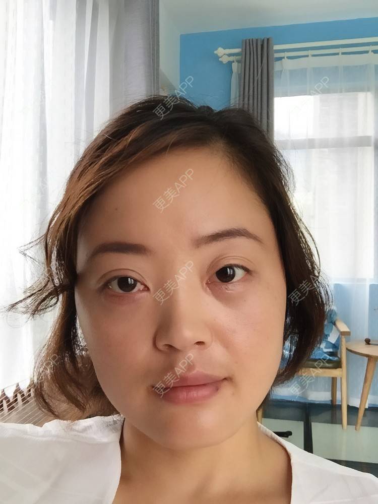 更美 - 寂静的样子的外切去眼袋经验 | 外切去眼袋 | 杭州