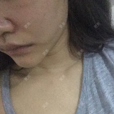轮廓修复
