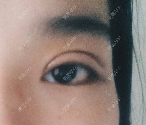 更美 - 圈圈小恐龙的双眼皮经验 | 美购日记 | 肿眼泡 | 双眼皮 | 长沙