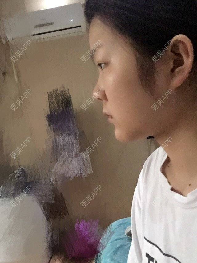 更美 - Mr .sun  shine的经验 | 除皱瘦脸 | 额头 | 垫眉弓 | 毛发移植 | 玻尿酸 | 宿州