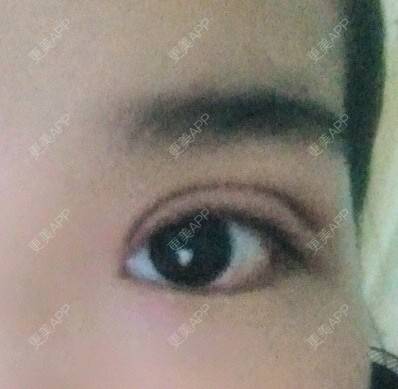 更美 - 圈圈小恐龙的双眼皮经验 | 美购日记 | 肿眼泡 | 双眼皮 | 长沙