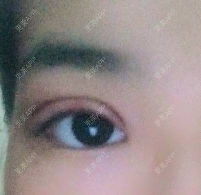 更美 - 圈圈小恐龙的双眼皮经验 | 美购日记 | 肿眼泡 | 双眼皮 | 长沙