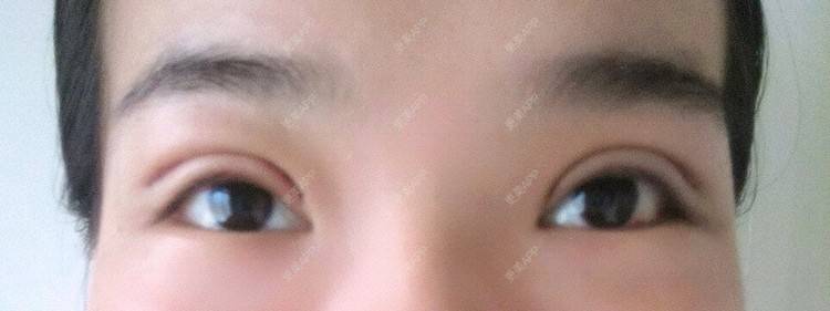 更美 - 圈圈小恐龙的双眼皮经验 | 美购日记 | 肿眼泡 | 双眼皮 | 长沙