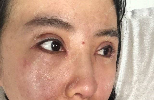 更美 - 娃娃呀的经验 | 鼻翼鼻头缩小 | 硅胶隆鼻 | 鼻中隔软骨垫鼻头 | 北京