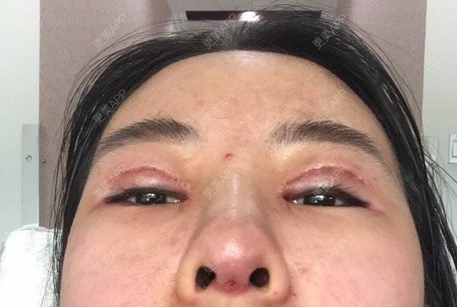 更美 - 娃娃呀的经验 | 鼻翼鼻头缩小 | 硅胶隆鼻 | 鼻中隔软骨垫鼻头 | 北京