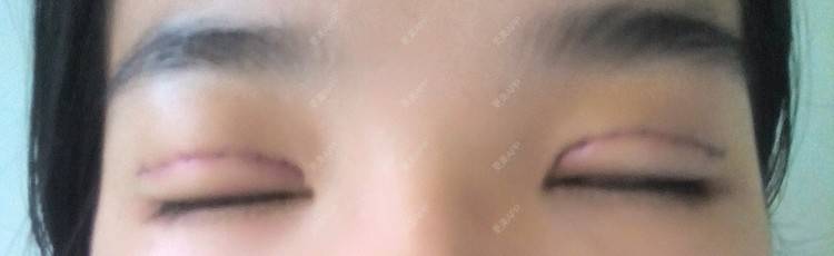 更美 - 圈圈小恐龙的双眼皮经验 | 美购日记 | 肿眼泡 | 双眼皮 | 长沙