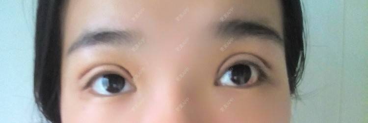 更美 - 圈圈小恐龙的双眼皮经验 | 美购日记 | 肿眼泡 | 双眼皮 | 长沙