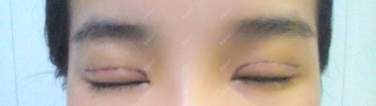更美 - 圈圈小恐龙的双眼皮经验 | 美购日记 | 肿眼泡 | 双眼皮 | 长沙