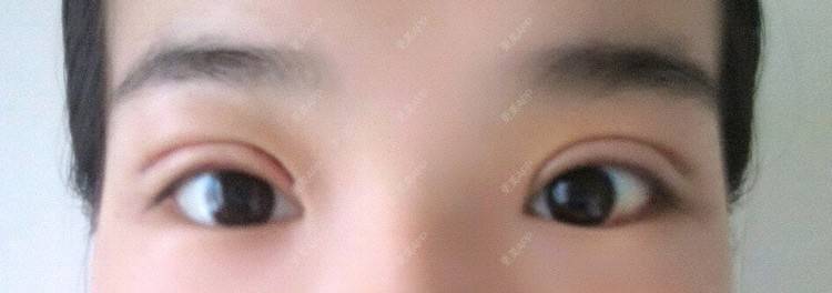 更美 - 圈圈小恐龙的双眼皮经验 | 美购日记 | 肿眼泡 | 双眼皮 | 长沙