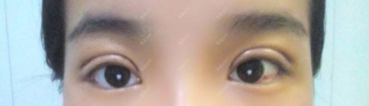 更美 - 圈圈小恐龙的双眼皮经验 | 美购日记 | 肿眼泡 | 双眼皮 | 长沙