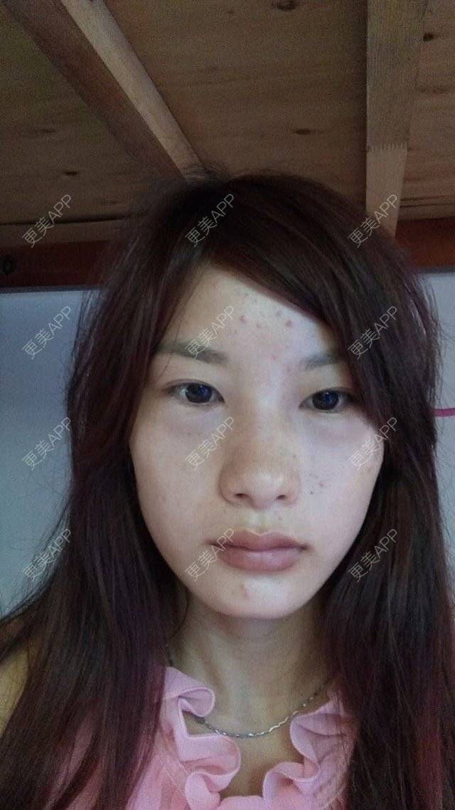 更美 - Shirley佳佳的激光去眼袋经验 | 广州 | 术后第一天 | 激光去眼袋 | 激光眼袋