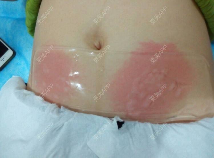 更美 - FRESKIN晶肤医疗美容（未央店）的微针淡化妊娠纹经验 | 微针淡化妊娠纹 | 妊娠纹 | 祛妊娠纹 | 西安