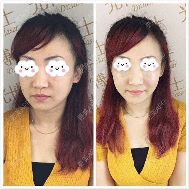 更美 - 🎀  _空气的玻尿酸苹果肌经验 | 注射美容 | 整形?why? | 玻尿酸苹果肌 | 晒对比照 | 重庆