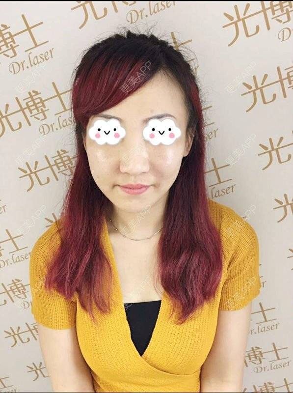 更美 - 🎀  _空气的玻尿酸苹果肌经验 | 注射美容 | 整形?why? | 玻尿酸苹果肌 | 晒对比照 | 重庆