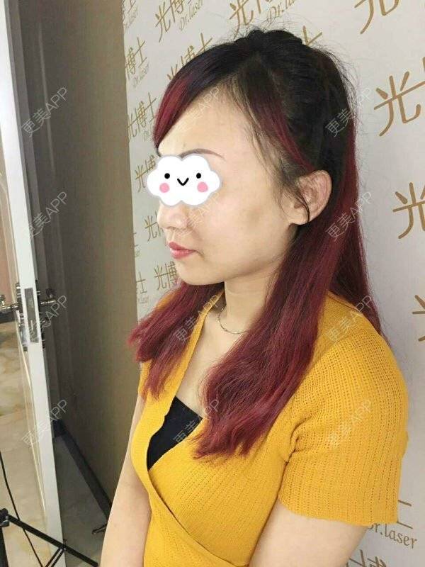 更美 - 🎀  _空气的玻尿酸苹果肌经验 | 注射美容 | 整形?why? | 玻尿酸苹果肌 | 晒对比照 | 重庆