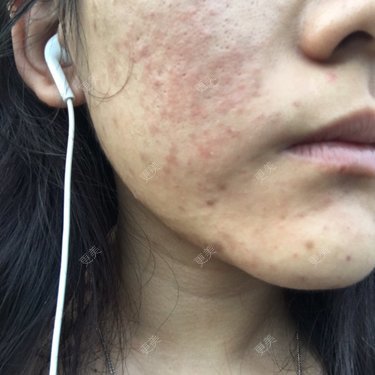 水光针后三天是否过敏了