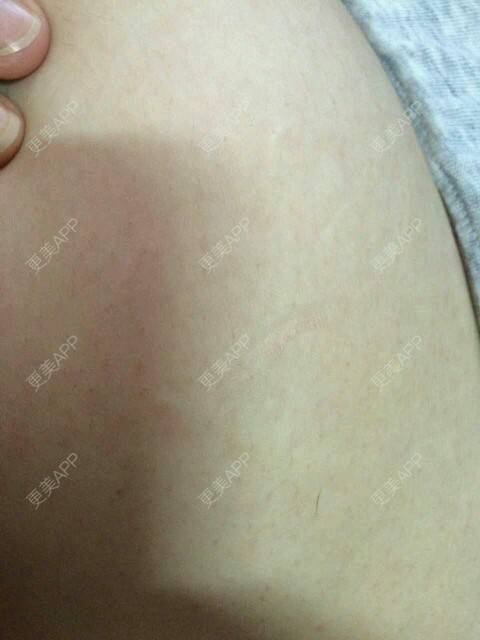 更美 - FRESKIN晶肤医疗美容（未央店）的微针淡化妊娠纹经验 | 晒对比照 | 妊娠纹 | 祛妊娠纹 | 微针淡化妊娠纹 | 西安