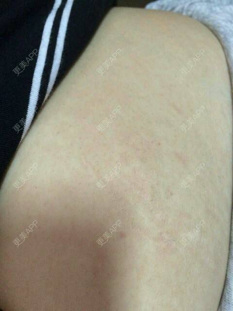 更美 - FRESKIN晶肤医疗美容（未央店）的微针淡化妊娠纹经验 | 晒对比照 | 妊娠纹 | 祛妊娠纹 | 微针淡化妊娠纹 | 西安