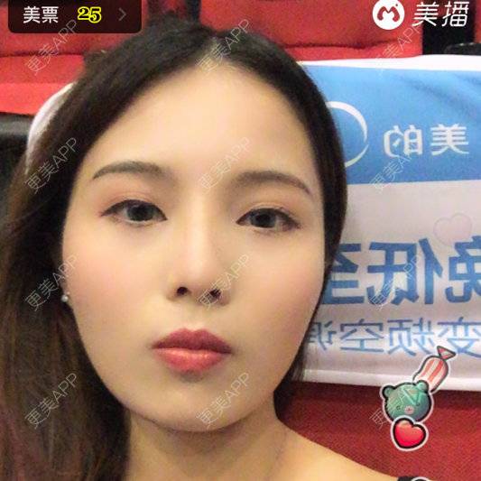 更美 - 🐰兔寶妞的经验 | 美购日记 | 隆鼻修复 | 术前清晰照 | 以前的我 | 广州