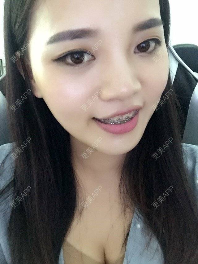 更美 - wu👙姑娘的经验 | 广州 | 矫正牙齿