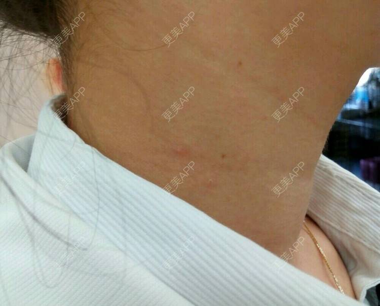更美 - 宋洋 医生的玻尿酸颈纹经验 | 晒对比照 | 微针 | 玻尿酸颈纹 | 西安