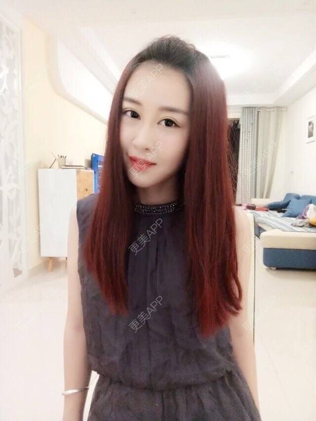 更美 - 小王王的经验 | 美购日记 | 终身包干 | 面部轮廓 | 自体脂肪填充面部手术 | 重庆