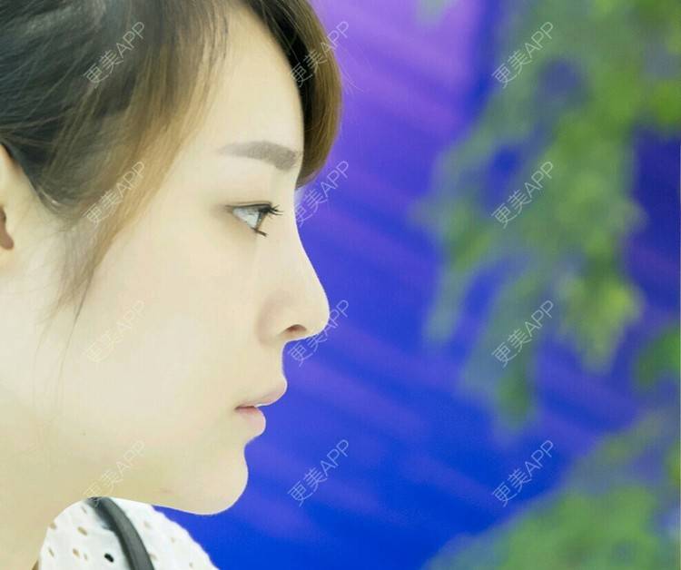 更美 - 更美用户HTqAVe5Wyw的鼻部多项经验 | 美购日记 | 隆鼻 | 鼻部多项 | 假体隆下巴 | 重庆