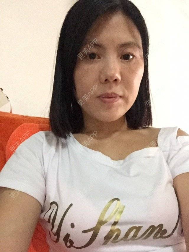 更美 - 微笑118的经验 | 童颜针 | 深圳